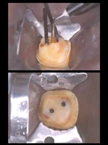 L'isolamento del campo operatorio in endodonzia - Doctor OS L'isolamento del campo operatorio in endodonzia - Doctor OS